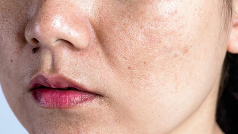 Phục Hồi Làn Da Khô Sạm Và Nhạy Cảm